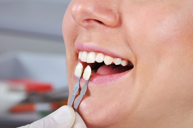 Люминиры на зубы: что это такое, в каких случаях применяется, отличия от виниров, этапы процедуры, преимущества
