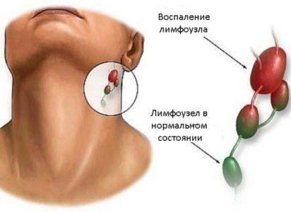 Маленькая горошинка под мочкой уха: причина образования шишки, симптомы и лечение