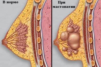 Мастопатия — симптомы и лечение, формы мастопатии, операция при мастопатии