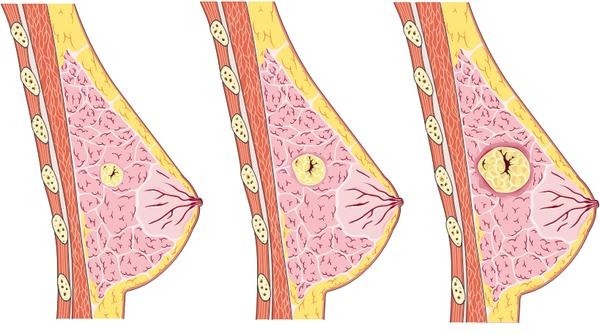 Мастопатия — симптомы и лечение, формы мастопатии, операция при мастопатии