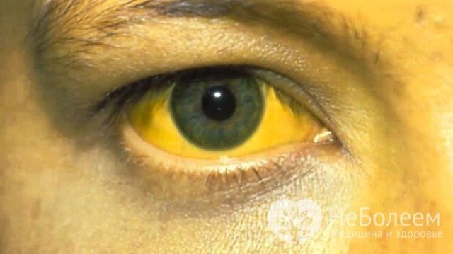 Механическая желтуха: что это такое, причины возникновения и симптомы, методы лечения