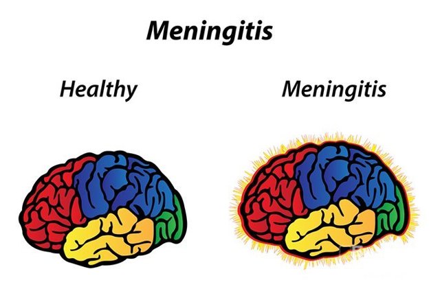 Менингит: симптомы, классификация, причины возникновения, лечение и возможные осложнения