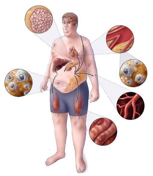 Метаболический синдром: механизм развития, клинические проявления, диагностика и тактика лечения, правила питания