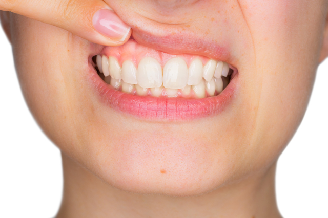 Метродент гель зубной (стоматологический): состав препарата, инструкция по применению – какие есть аналоги?