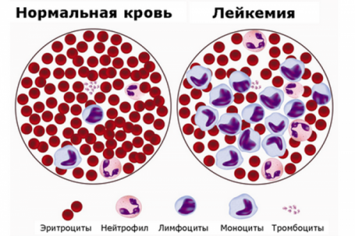 Множественная миелома крови: провоцирующие факторы, характерные симптомы, особенности лечения и прогноз