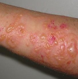 Мокнущий дерматит: причины развития, характерные симптомы с подробными фото, методы лечения и профилактики
