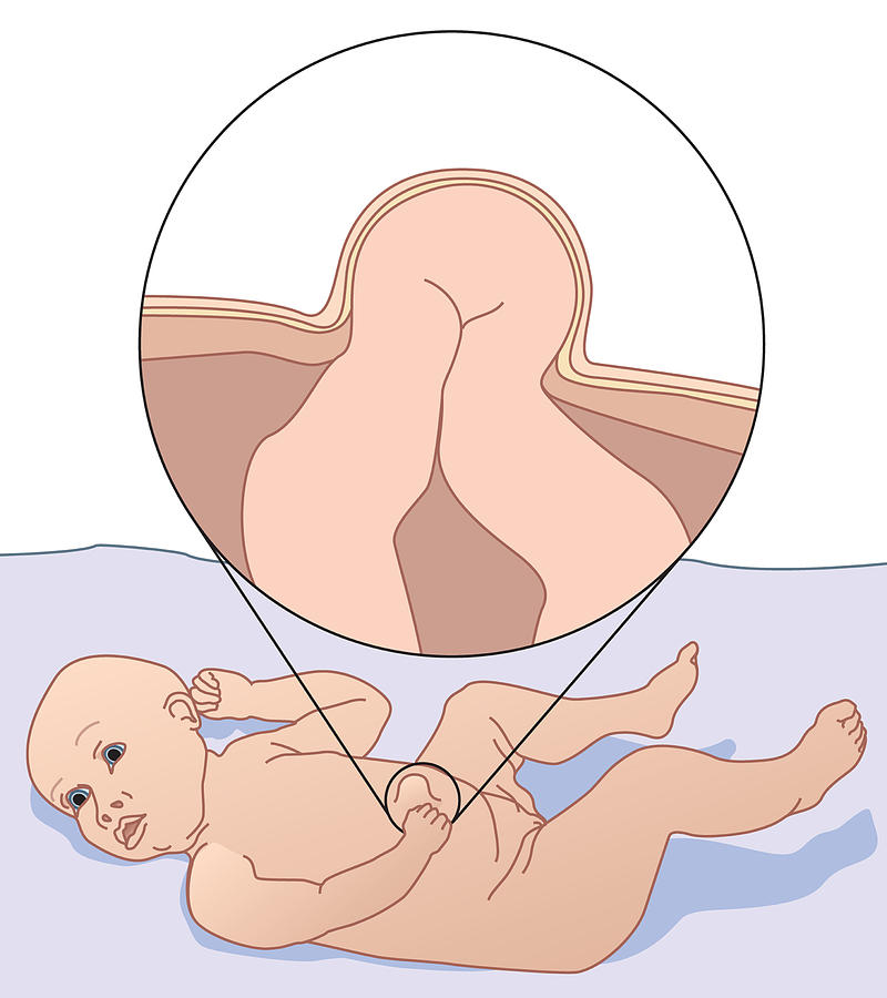 Мокнущий пупок у новорожденных: симптомы и лечение омфалита у младенцев