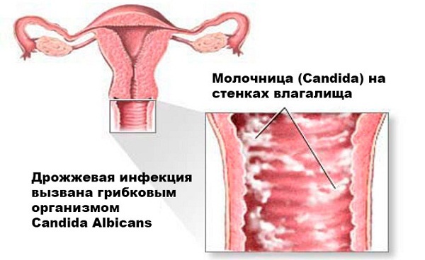 Молочница при грудном вскармливании у кормящей матери: симптомы, безопасные препараты для лечения