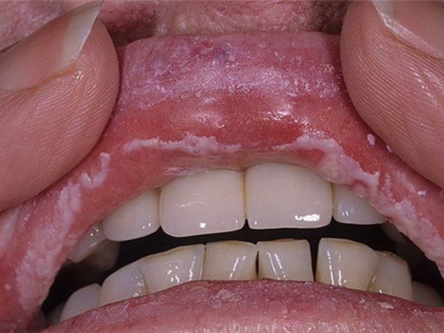 Молочница во рту: причины возникновения, симптомы и методы лечения орального кандидоза с подробными фото