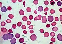 Может гемолитическая анемия перейти в железодефицитную анемию?