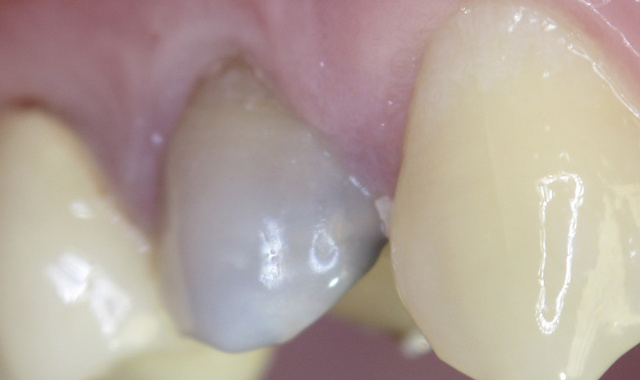 Может закладывать мышьяк детям стоматолог при лечении зубов?