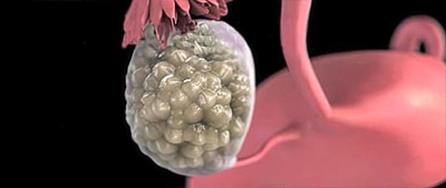 Мультифолликулярные яичники: причины развития, характерные признаки, методы обследования и терапии