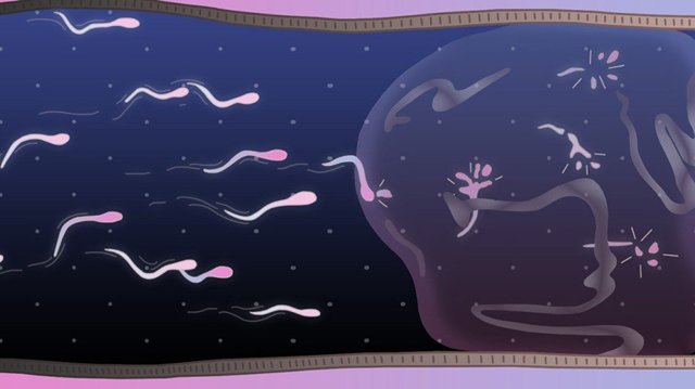 Мужская контрацепция: виды, способы применения, надежность средств