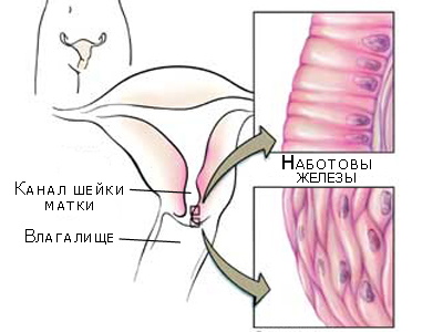 Наботова киста шейки матки: провоцирующие факторы, характерные симптомы, принципы лечения и возможные осложнения