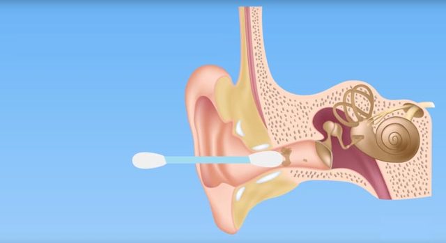 Наружный отит, «ухо пловца»: причины возникновения, клинические проявления, диагностика и способы лечения