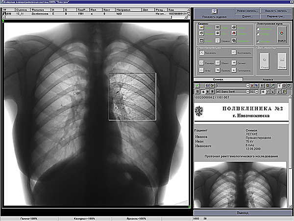 Насколько точны результаты флюорографии при диагностике пневмонии и бронхита?
