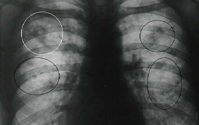 Насколько точны результаты флюорографии при диагностике пневмонии и бронхита?