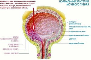 Нейрогенный мочевой пузырь: лечение у женщин, детей и мужчин, профилактика и прогноз