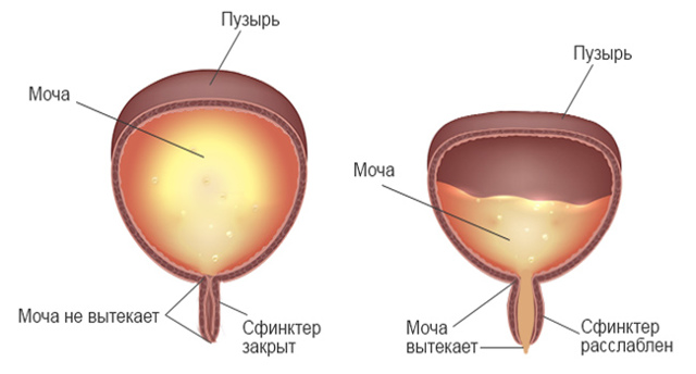 Нейрогенный мочевой пузырь: лечение у женщин, детей и мужчин, профилактика и прогноз