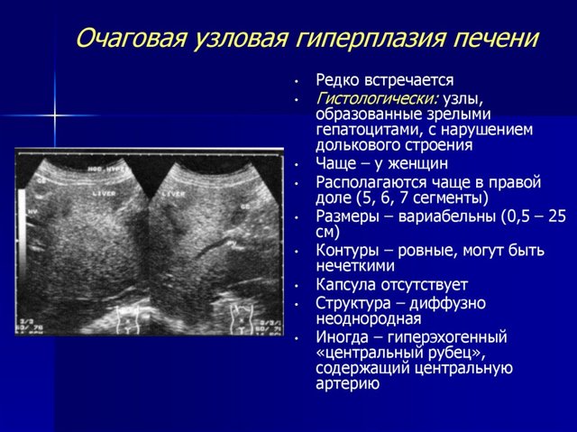 Нодулярная гиперплазия печени: причины развития, клинические проявления, способы диагностирования и лечения