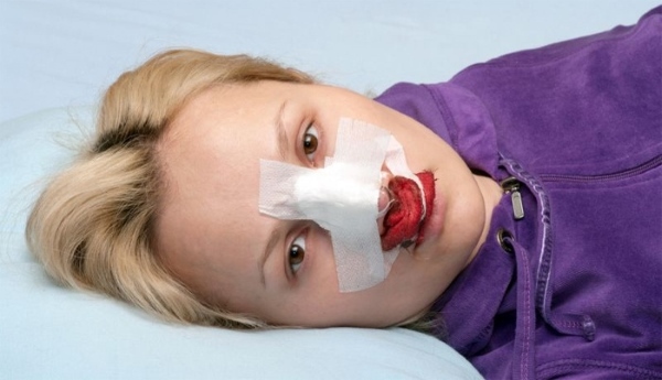 Носовое кровотечение у детей и взрослых: причины частых носовых кровотечений, первая помощь при носовом кровотечении и методы остановки кровотечения из носа