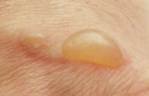 О какой болезни говорит высыпание пузырей на коже?