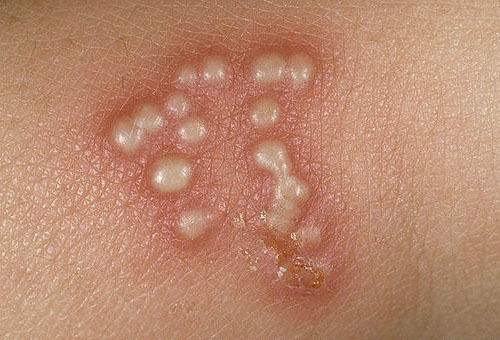 О какой болезни говорит высыпание пузырей на коже?