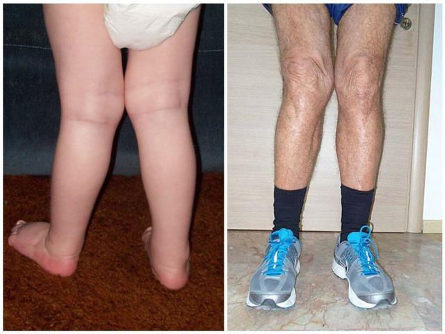 О-образные ноги, варусная деформация у ребенка и взрослого: причины развития, клинические проявления, способы лечения и меры профилактики