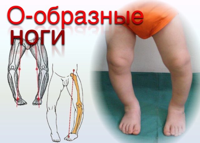 О-образные ноги, варусная деформация у ребенка и взрослого: причины развития, клинические проявления, способы лечения и меры профилактики