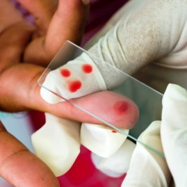 Общий анализ крови: нормы, расшифровка анализа крови, подготовка к анализу крови