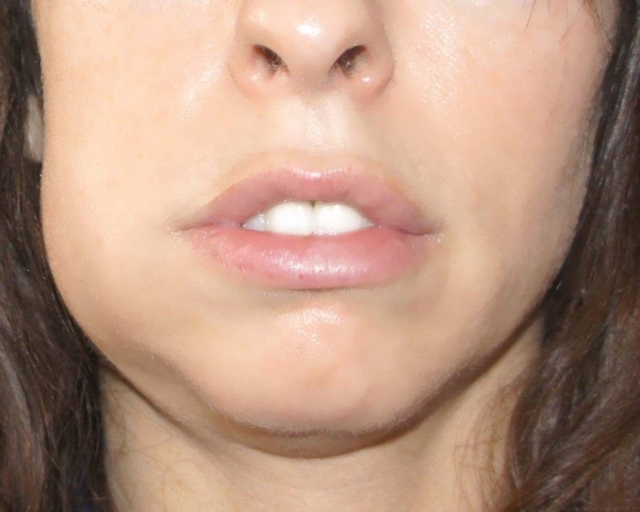 Опухла щека, но зуб не болит: причины воспаления, как снять опухоль, что делать с отеком внутри полости рта