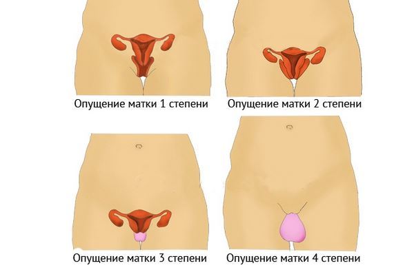 Опущение матки: симптоматика и последствия заболевания, гимнастика и полезные упражнения