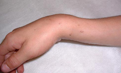 Оскольчатый перелом локтевой кости руки со смещением и без: последствия, лечение, операция