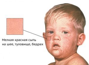 Осложнения после прививки от дифтерии, кори и краснухи, полиомиелита, гепатита: симптомы, профилактика
