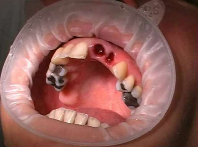 Осложнения после удаления зуба: сухая лунка, воспалительные процессы, медицинский контроль и лечение