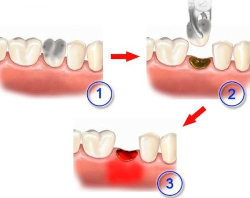 Осложнения после удаления зуба: сухая лунка, воспалительные процессы, медицинский контроль и лечение