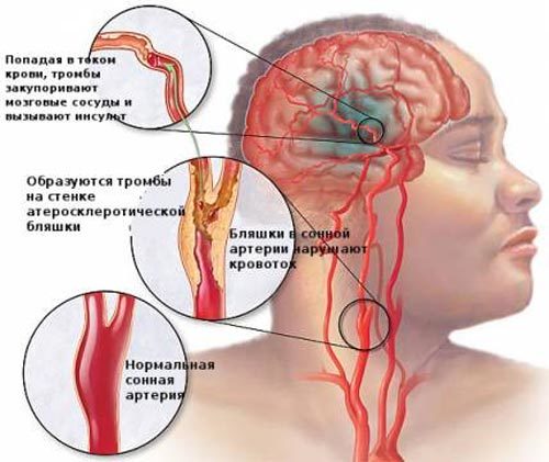Особенности проведения УЗИ сосудов головного мозга и шеи: суть ультразвукового исследования