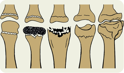 Остеохондропатия плюсневой кости стопы у ребенка и взрослого: причины возникновения, основные симптомы, диагностика и тактика лечение