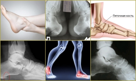 Остеохондропатия плюсневой кости стопы у ребенка и взрослого: причины возникновения, основные симптомы, диагностика и тактика лечение