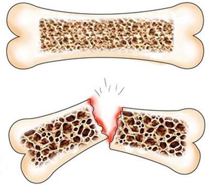 Остеомаляция бедренной кости, бедра: факторы риска развития, клинические проявления, принципы лечения и профилактика