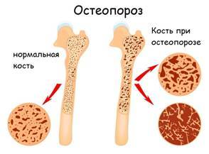 Остеомаляция: механизм развития, сопутствующие симптомы, методы терапии, отличие от остеопороза