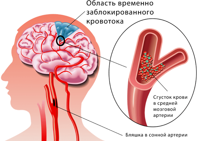 Острое и хроническое нарушение мозгового кровообращения: клинические симптомы и лечение патологии 