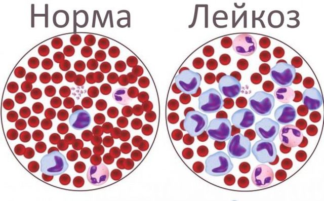 Острый лейкоз: разновидности и причины рака крови, современные методы лечения и прогноз