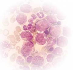 Острый лейкоз: разновидности и причины рака крови, современные методы лечения и прогноз
