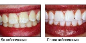Отбеливание зубов opalescence boost, домашнее отбеливание зубов с капами: что это