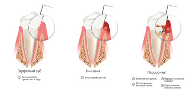 Отек десны возле зуба: причины воспаления, методы лечения, применение полосканий
