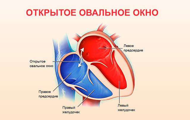 Открытое овальное окно в сердце: причины развития, характерные симптомы, диагностика и тактика лечения