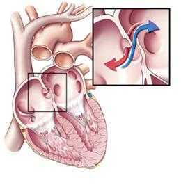 Открытое овальное окно в сердце: причины развития, характерные симптомы, диагностика и тактика лечения