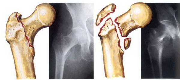 Открытый перелом бедренной кости со смещением и без: неотложная помощь, особенности лечения, сроки восстановления