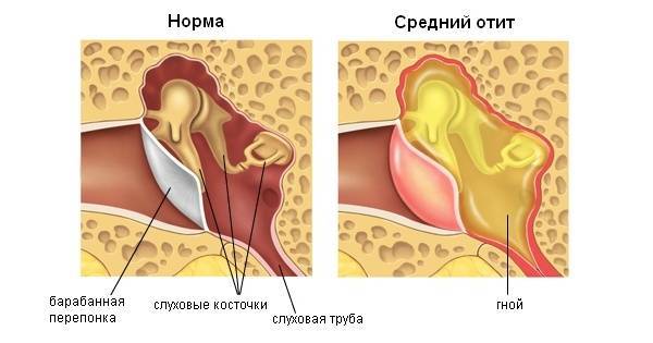 Отомикоз: симптомы, самые эффективные препараты для лечения грибка ушей